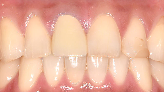 審美治療ケース