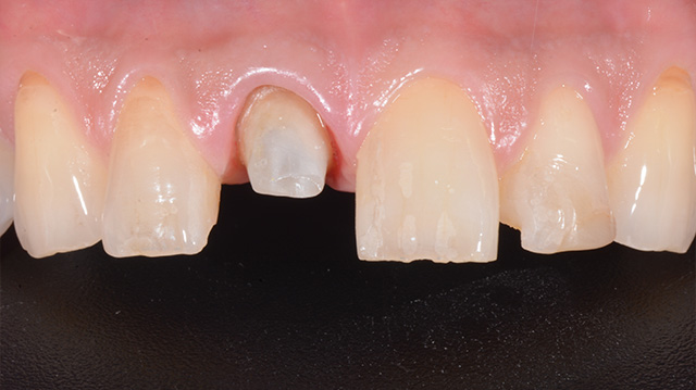 審美治療ケース