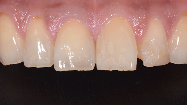 審美治療ケース