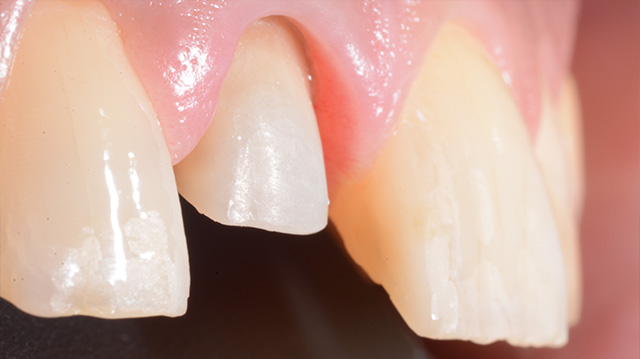 審美治療ケース