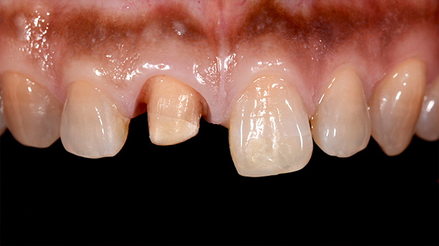 審美治療ケース