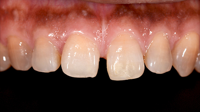 審美治療ケース