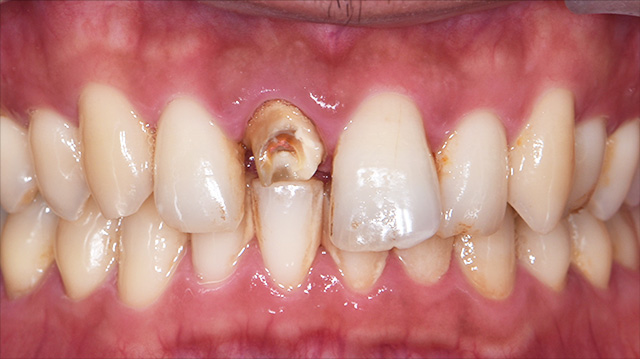 審美治療ケース