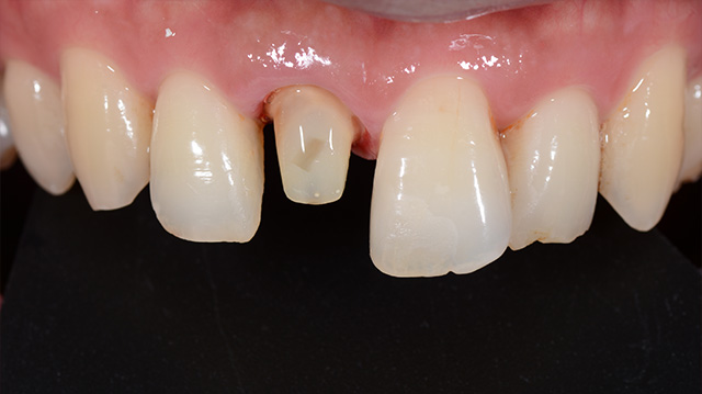 審美治療ケース