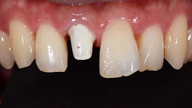 審美治療ケース