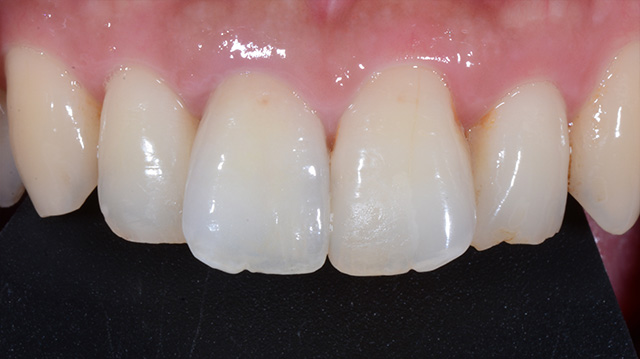 審美治療ケース