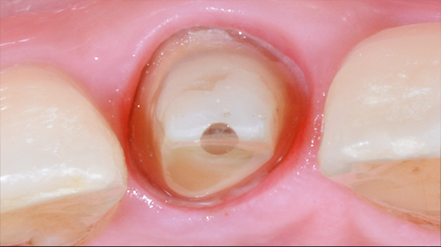 審美治療ケース