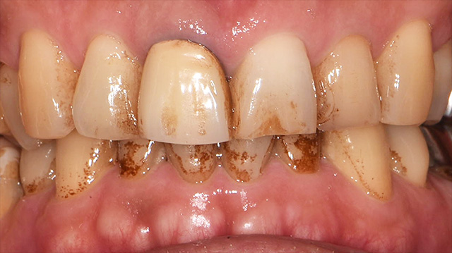 審美治療ケース