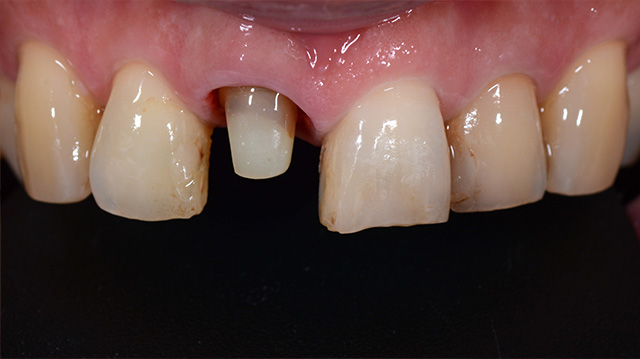 審美治療ケース