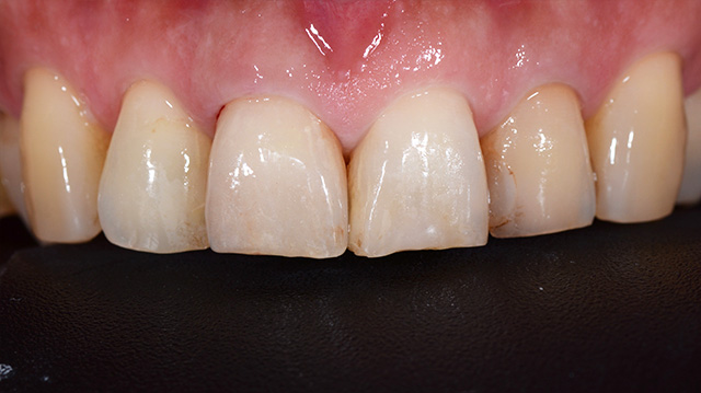 審美治療ケース