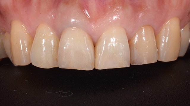 審美治療ケース