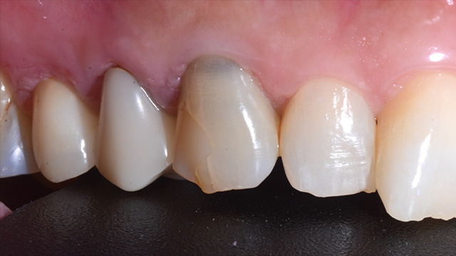 審美治療ケース