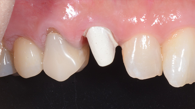 審美治療ケース