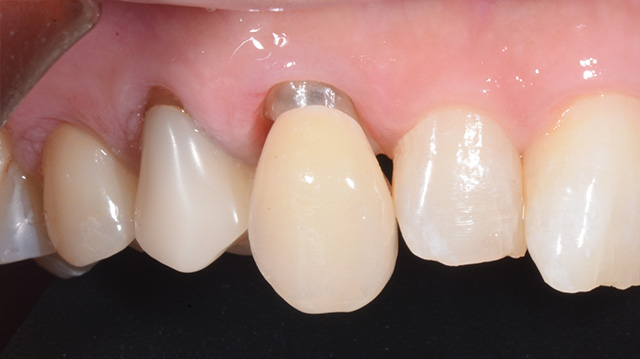 審美治療ケース