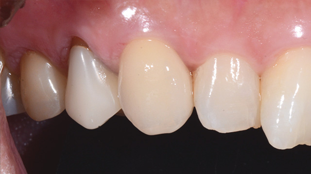 審美治療ケース