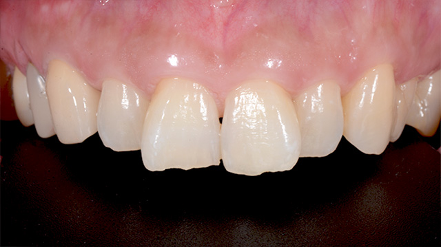 審美治療ケース