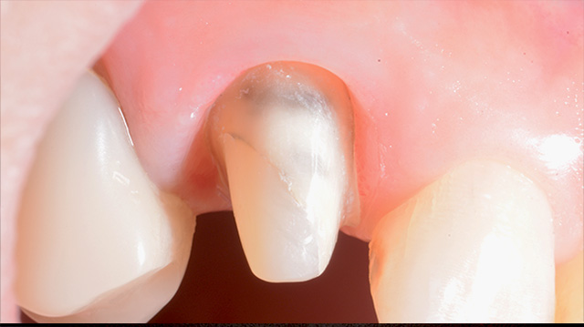 審美治療ケース