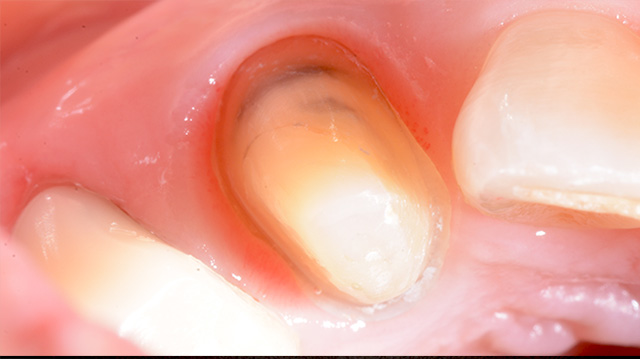 審美治療ケース