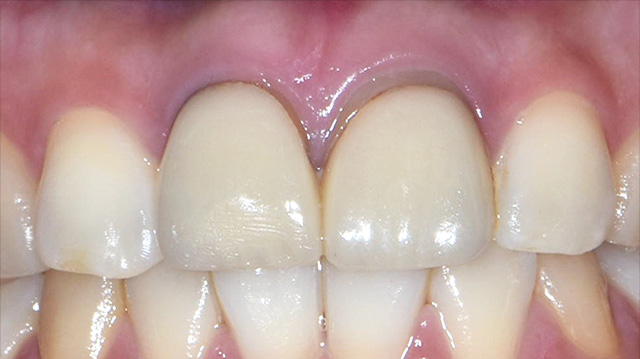 審美治療ケース