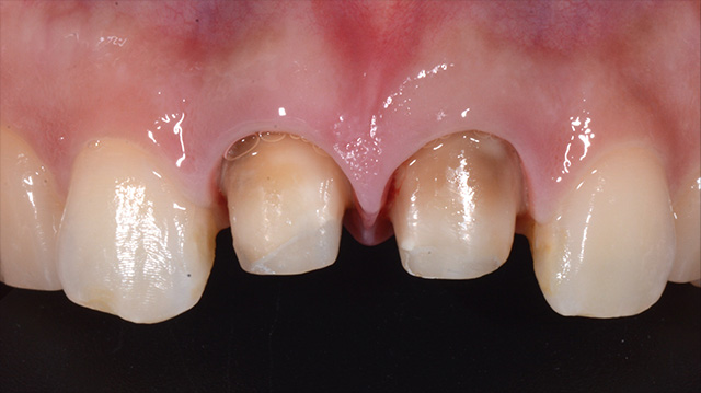 審美治療ケース