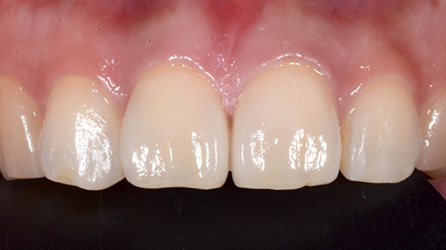 審美治療ケース