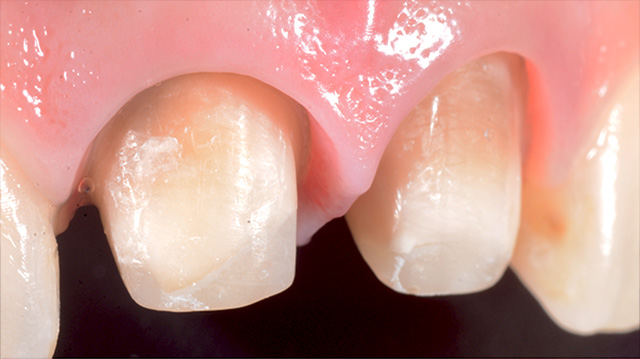 審美治療ケース