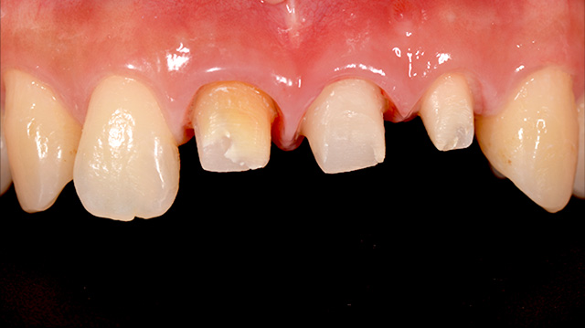 審美治療ケース