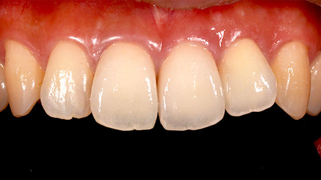 審美治療ケース