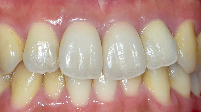 審美治療ケース