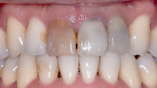 審美治療ケース