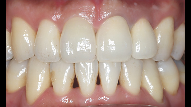 審美治療ケース