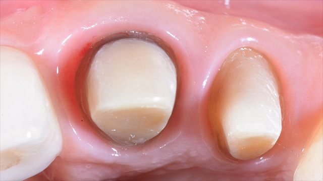 審美治療ケース