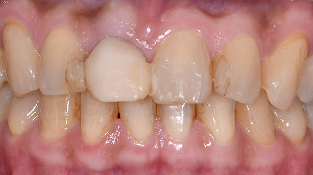 審美治療ケース