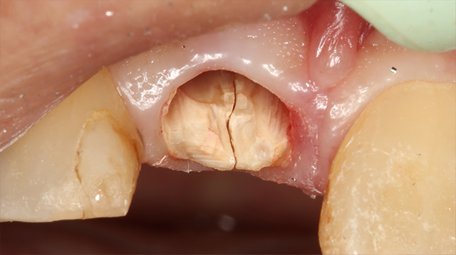 審美治療ケース