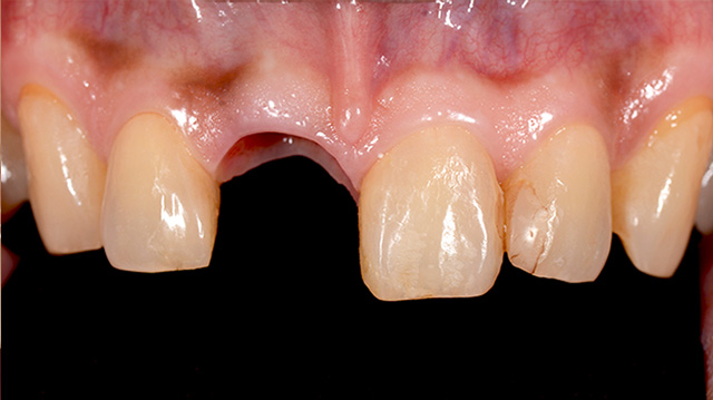 審美治療ケース