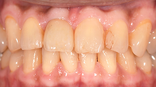 審美治療ケース