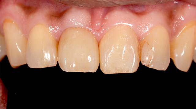 審美治療ケース