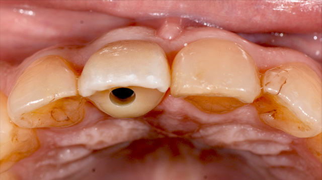審美治療ケース