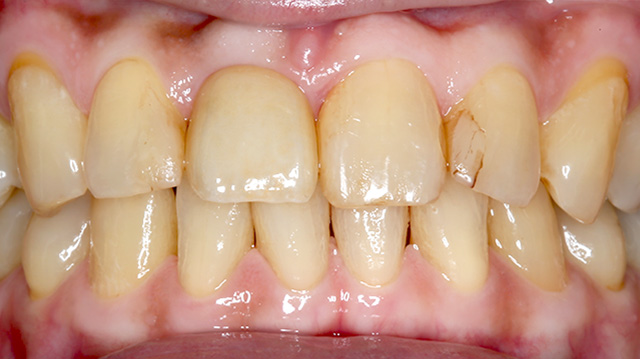 審美治療ケース