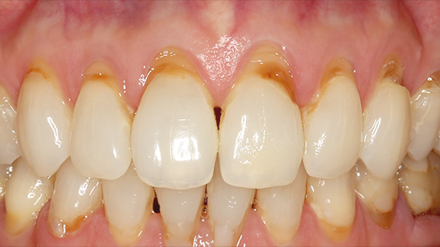 審美治療ケース