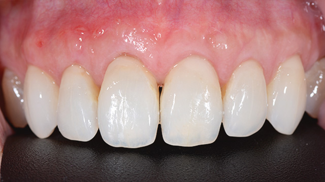 審美治療ケース