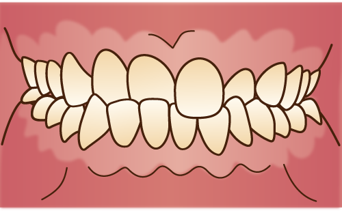 交叉咬合(こうさこうごう)