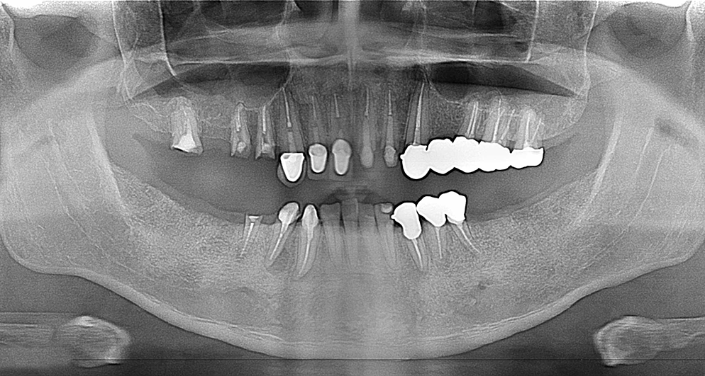 レントゲン写真
