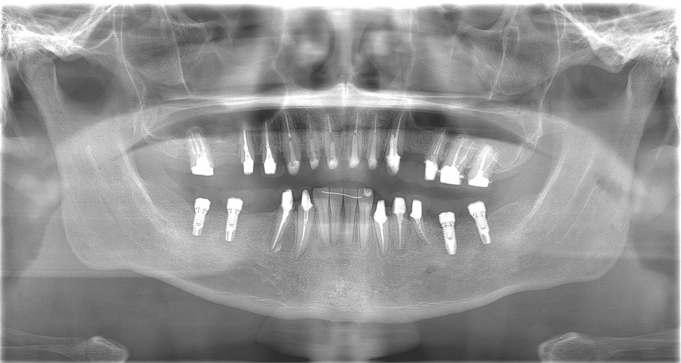 レントゲン写真