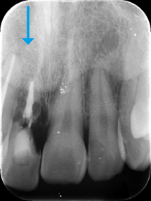 レントゲン写真