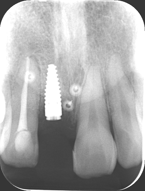 レントゲン写真